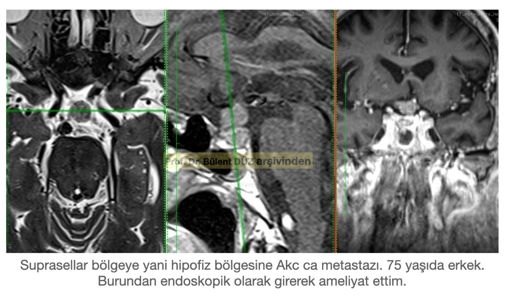 75 yaşındaki erkek hastada suprasellar bölgeye yerleşmiş akciğer kanseri metastazının aksiyel, sagital ve koronal MR görüntüleri