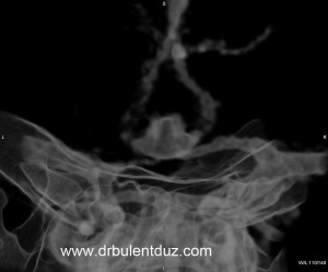 anterior_communican_arter_anevrizması_mr-dr_bulent_duz