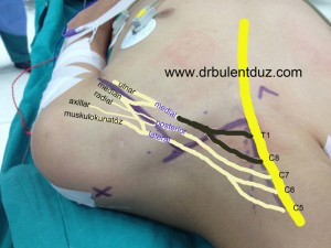 boyunda_sinir_kopması_ameliyatı_operator_doktor_bulent_duz