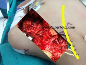 boyunda_sinir_kopması_ameliyatı_en_iyi_doktor_bulent_duz