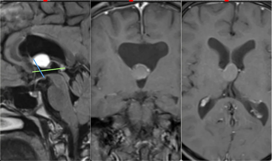 Üçüncü ventrikül kolloid kistinin sagittal, koronal ve aksiyel MR görüntüleri