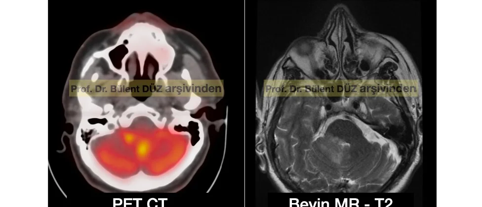 Primer beyin lenfomasında PET-CT ve T2 MR görüntüleri, Prof. Dr. Bülent Düz arşivinden
