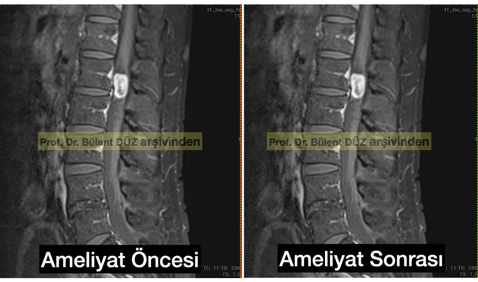 Spinal intradural schwannomun ameliyat öncesi ve sonrası sagittal MR görüntüleri