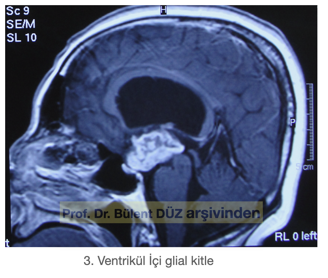 Üçüncü ventrikül içerisinde yerleşmiş glial tümör MR görüntüsü