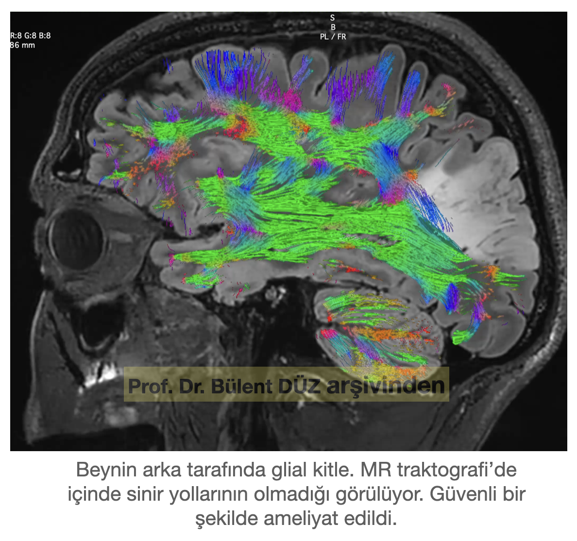 Glial tümörün MR traktografi ile sinir yollarıyla ilişkisinin değerlendirilmesi