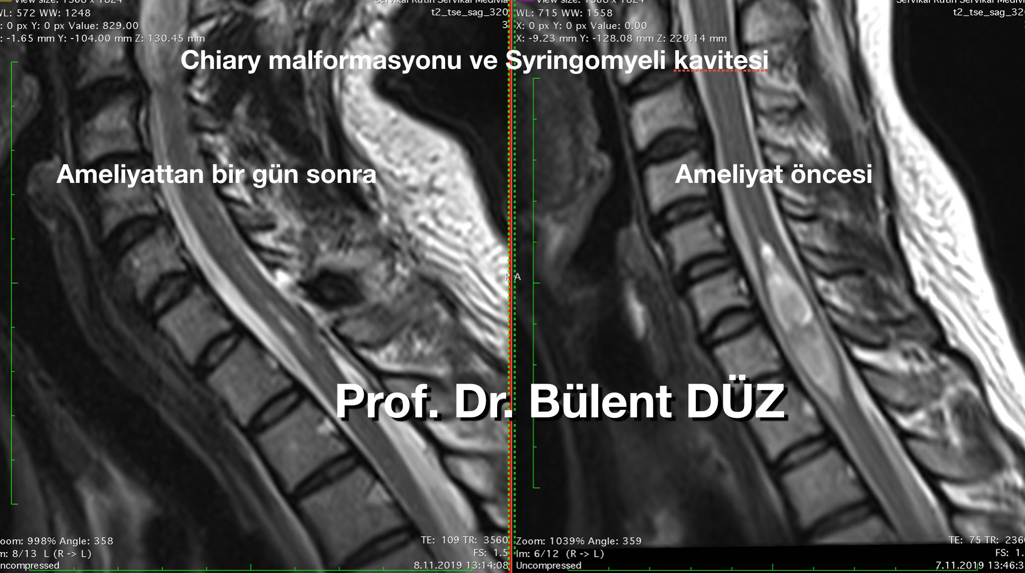 siringomyeli_ameliyatı_en_iyi_op_doktor_bulent_duz