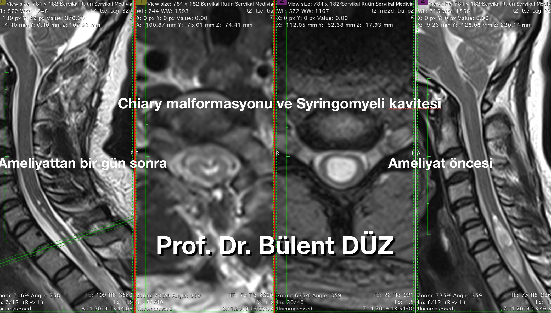 siringomyeli_ameliyatı_en_iyi_doktor_bulent_duz