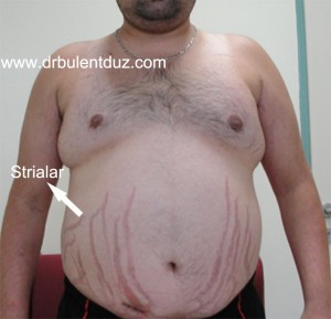 Cushing hastalığında karın bölgesinde görülen mor-kırmızı strialar