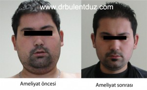 Cushing Hastalığı