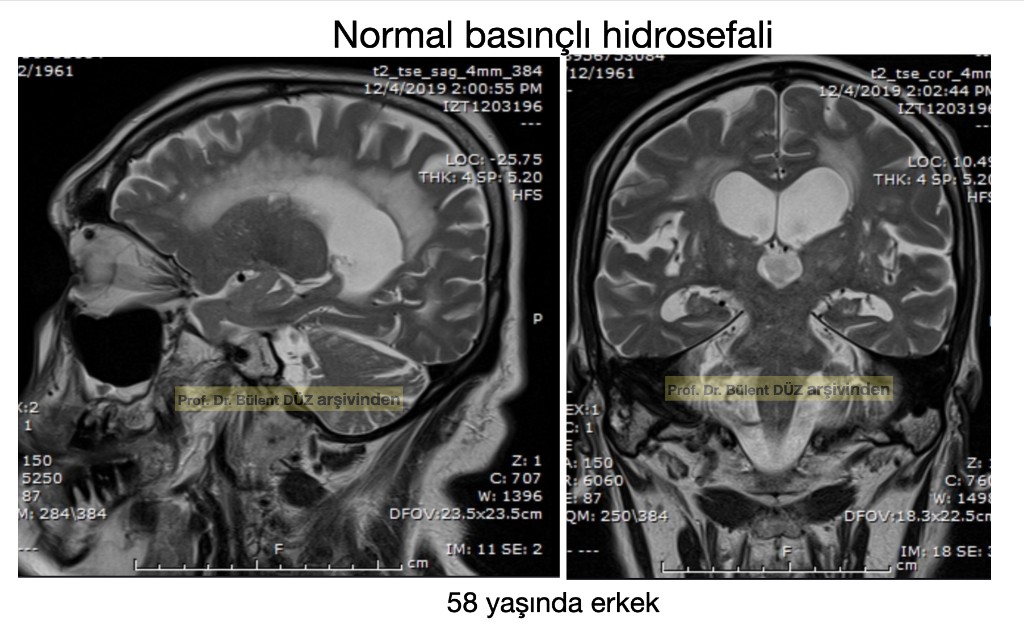 58 yaşındaki hastanın normal basınçlı hidrosefali sagittal ve koronal T2 beyin MR görüntüleri
