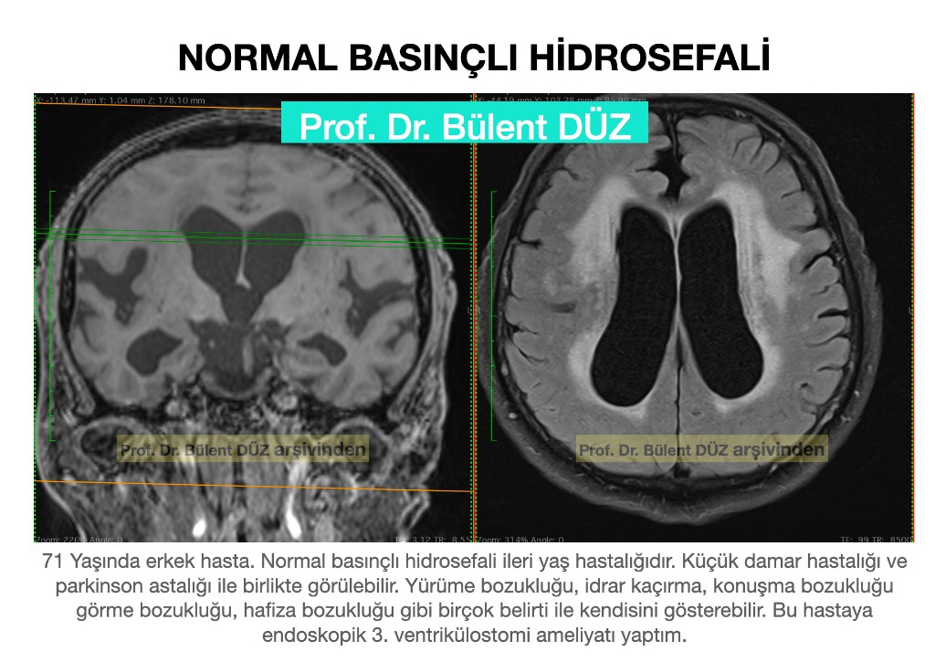 71 yaşındaki hastanın ventrikül genişlemesi ve beyaz cevher değişikliklerini gösteren koronal ve aksiyel beyin MR görüntüleri