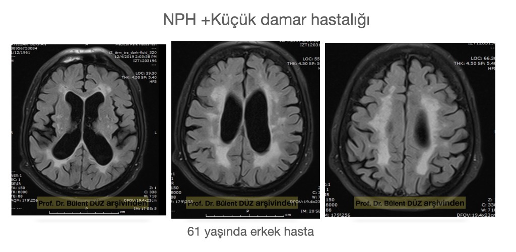 61 yaşındaki erkek hastanın NPH ve küçük damar hastalığına ait üç aksiyel FLAIR beyin MR görüntüsü