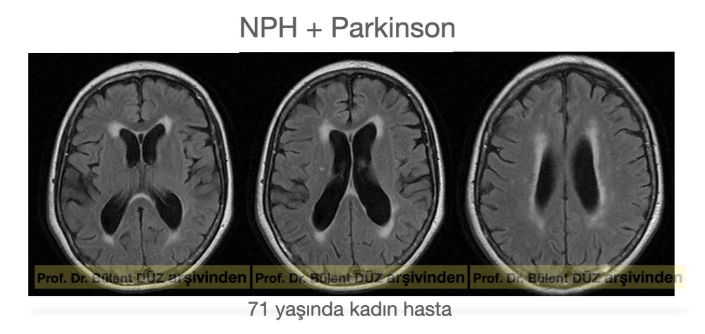71 yaşındaki kadın hastanın NPH ve Parkinson ile ilişkili üç aksiyel beyin MR görüntüsü