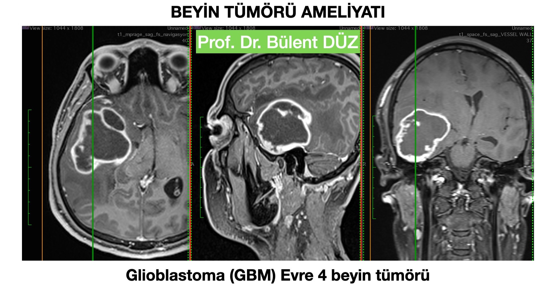 GBM - R temporal- bulent duz_edited.jpg