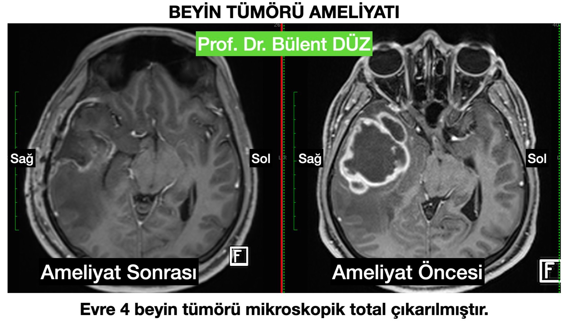 GBM - R temporal 2- bulent duz_edited.jpg