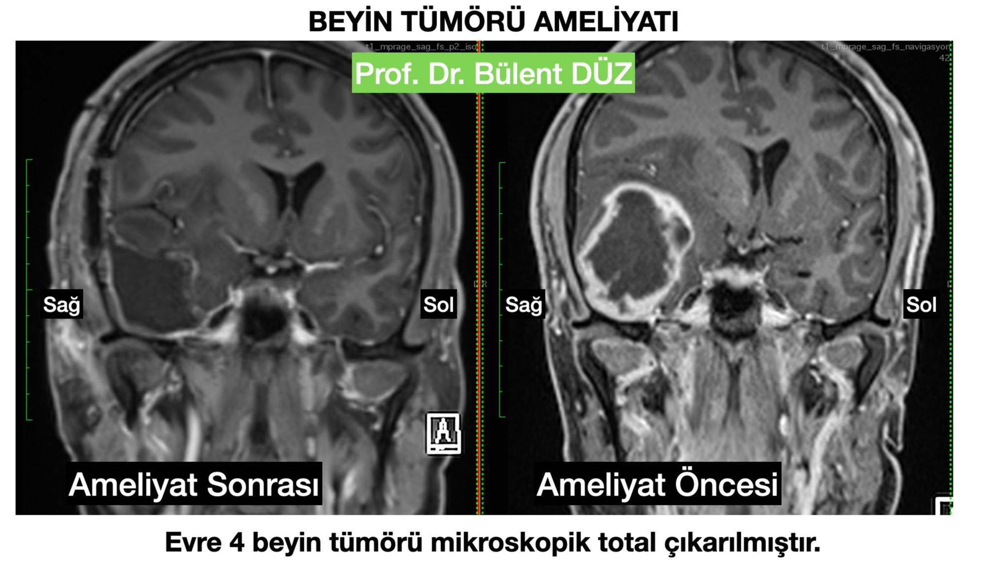 GBM - R temporal 3- bulent duz_edited.jpg