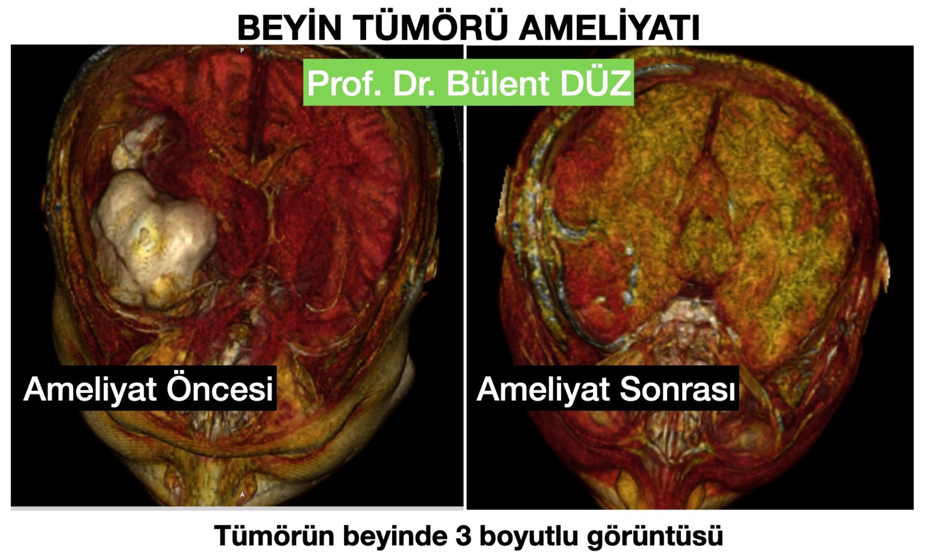 GBM - R temporal 4- bulent duz_edited.jpg
