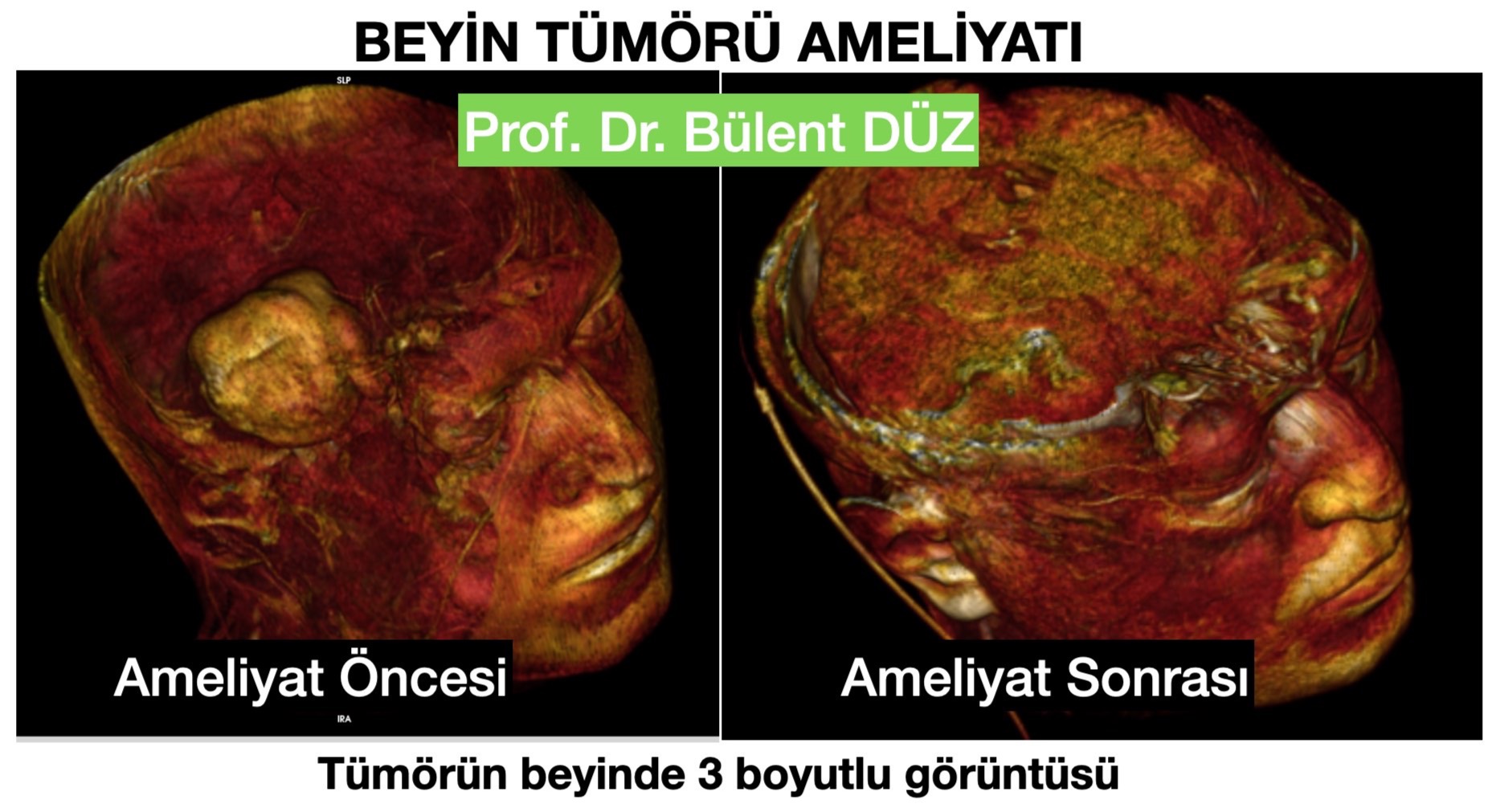 GBM - R temporal 5- bulent duz_edited.jpg
