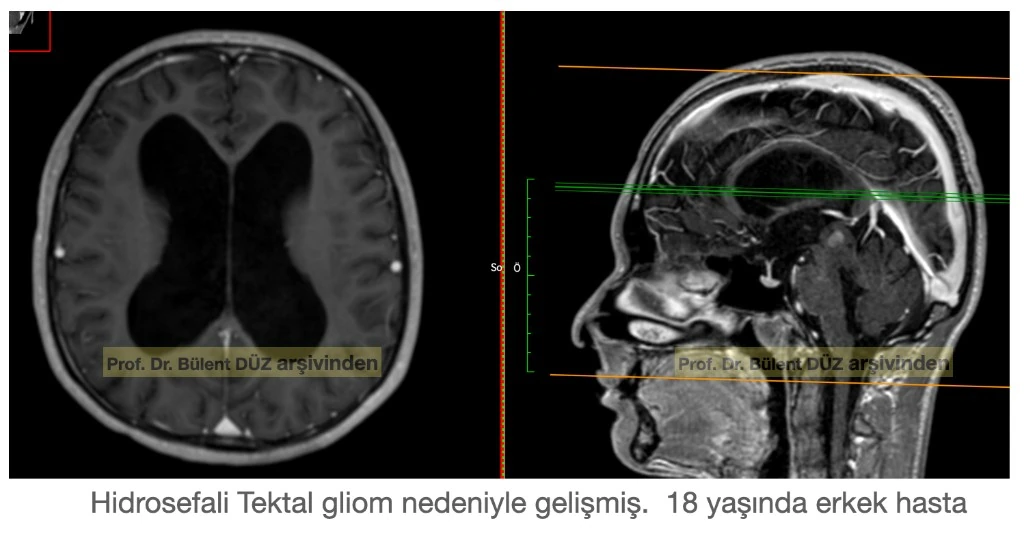 Tektal gliomaya bağlı obstrüktif hidrosefali ve genişlemiş beyin ventrikülleri MR görüntüsü