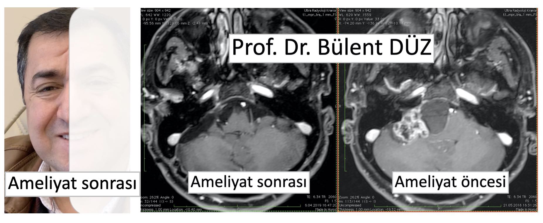 CPA_angle_tumor_prof_dr_bulent duz