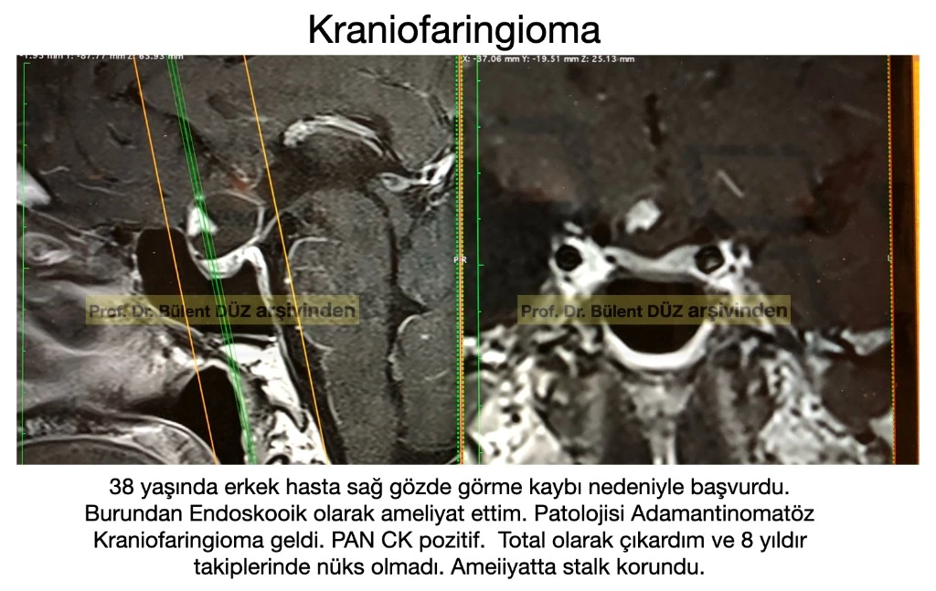 Adamantinomatöz kraniofaringioma sagittal ve koronal MR görüntüsü