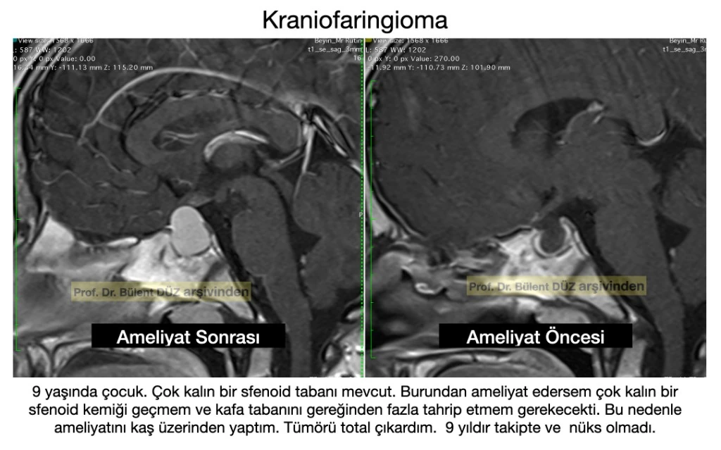 Çocukta supraorbital yaklaşımla kraniofaringioma ameliyatı öncesi ve sonrası MR görüntüleri