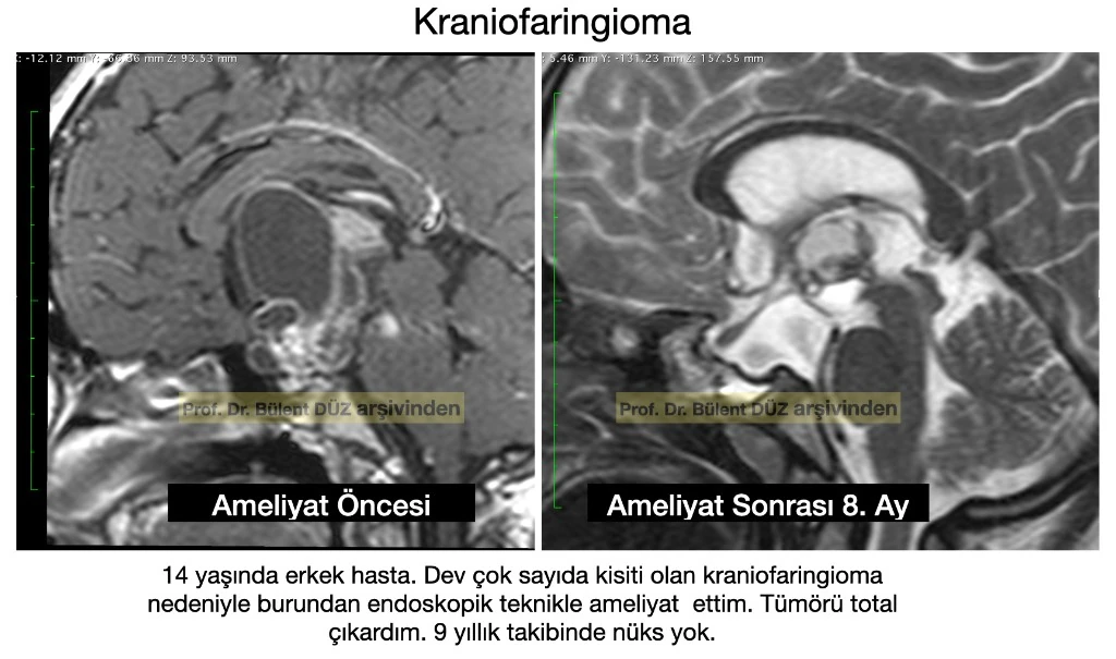 14 yaşındaki çocukta büyük multikistik kraniofaringioma ameliyat öncesi ve sonrası MR görüntüleri