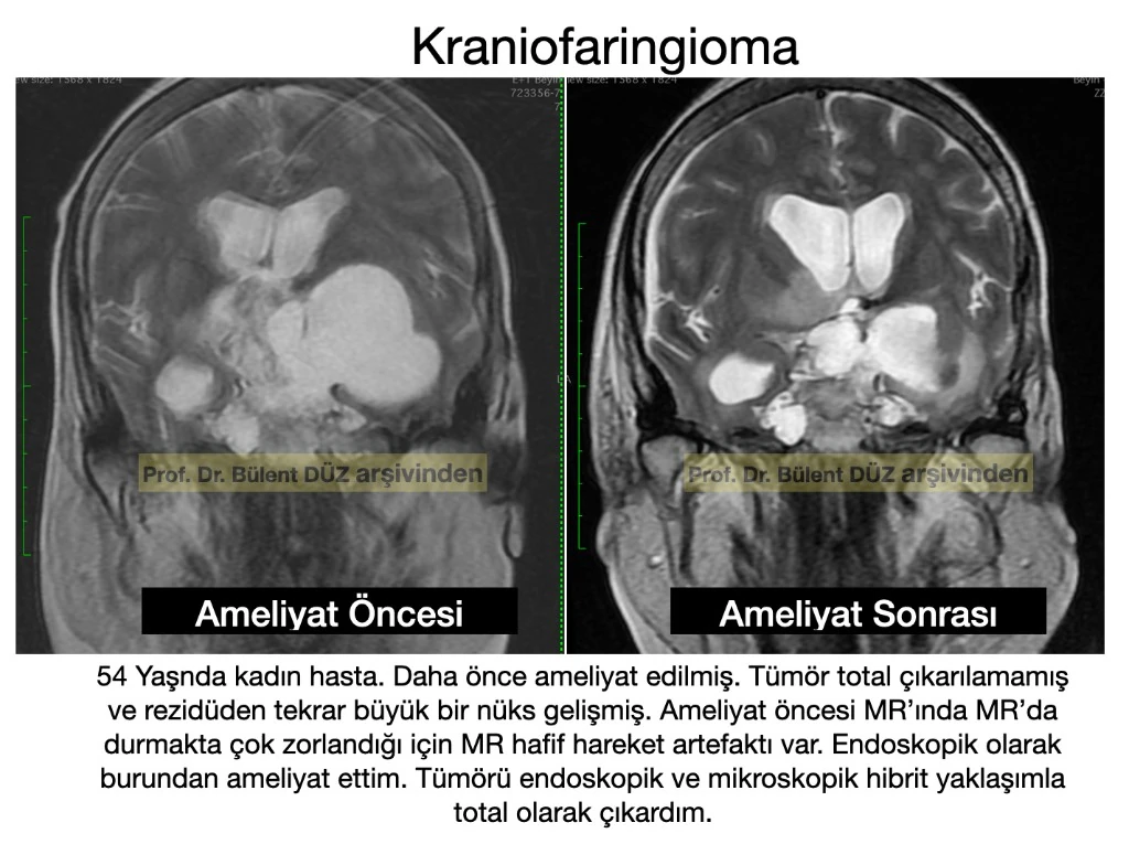 Büyük rezidü ve nüks kraniofaringioma ameliyat öncesi ve sonrası MR görüntüleri