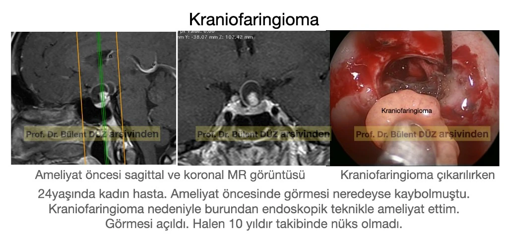 Endoskopik kraniofaringioma ameliyatı MR ve ameliyat içi endoskopik görüntüsü