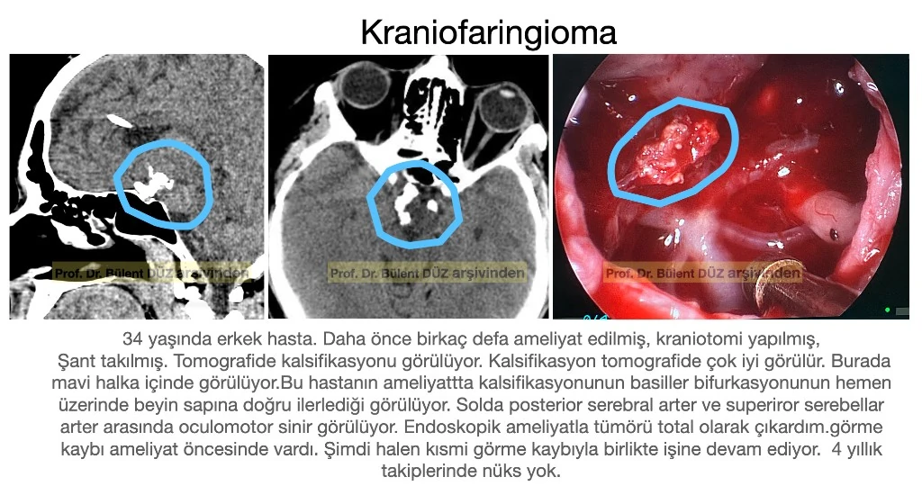 Kalsifiye nüks kraniofaringiomanın BT ve endoskopik ameliyat görüntüsü