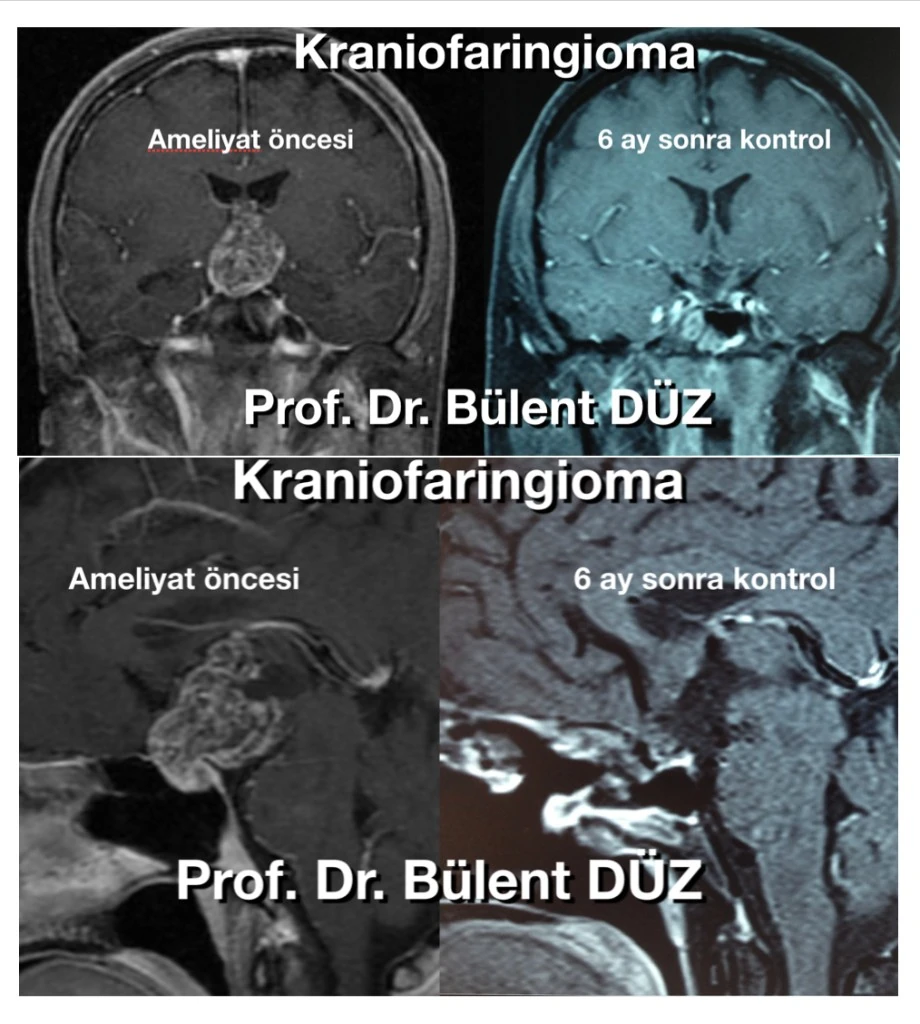 Üçüncü ventrikülü dolduran kraniofaringioma ve endoskopik ameliyat sonrası uzun dönem takip