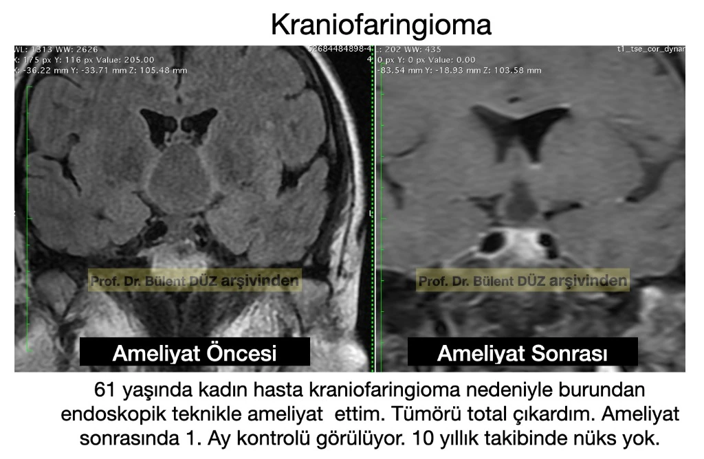 Kraniofaringioma endoskopik ameliyat öncesi ve sonrası koronal MR görüntüleri