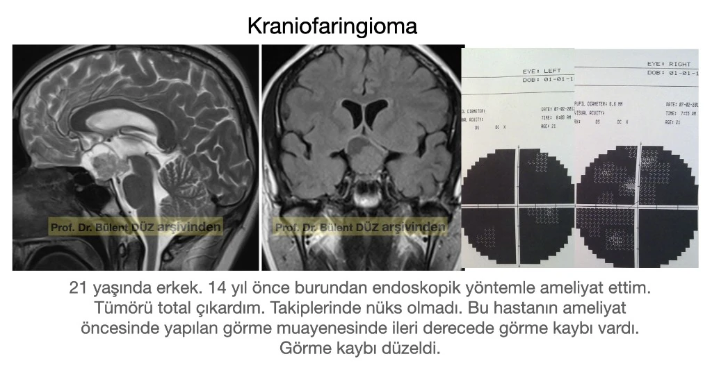 Kraniofaringiomaya bağlı görme kaybı olan hastanın MR ve görme alanı incelemesi