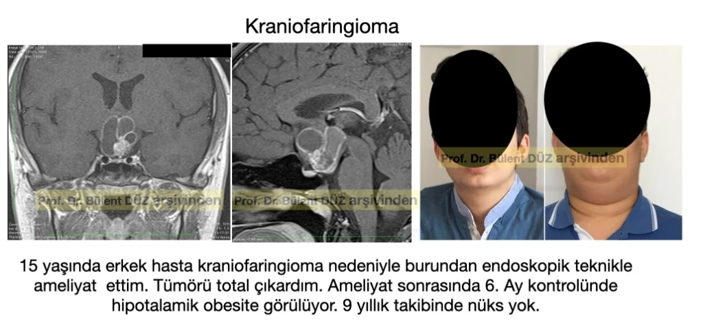 Kraniofaringioma ameliyatı sonrası hipotalamik obezite gelişen çocuk hastanın anonimleştirilmiş klinik görüntüsü ve MR