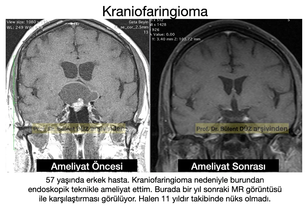 Kraniofaringioma ameliyatı öncesi ve sonrası MR ve uzun dönem takip görüntüleri