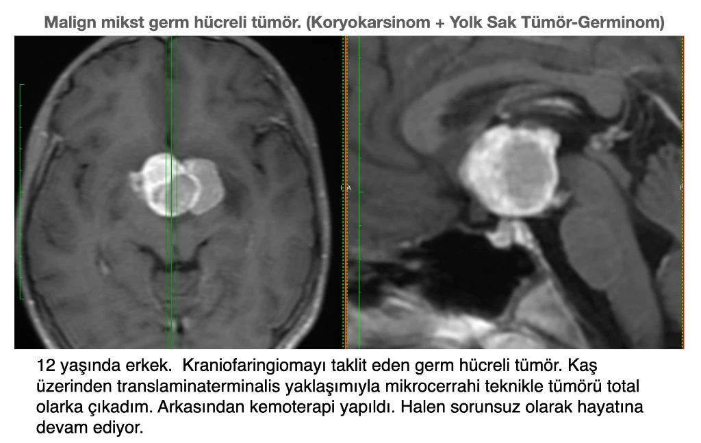 Kraniofaringiomayı taklit eden üçüncü ventrikül malign mikst germ hücreli tümörü MR görüntüsü