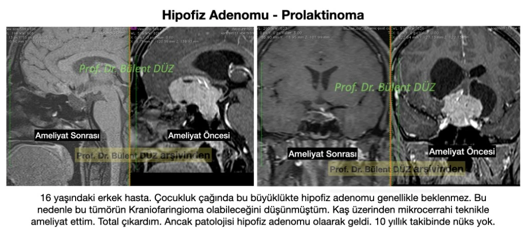 Kraniofaringiomayı taklit eden dev hipofiz adenomu ameliyat öncesi ve sonrası MR görüntüleri