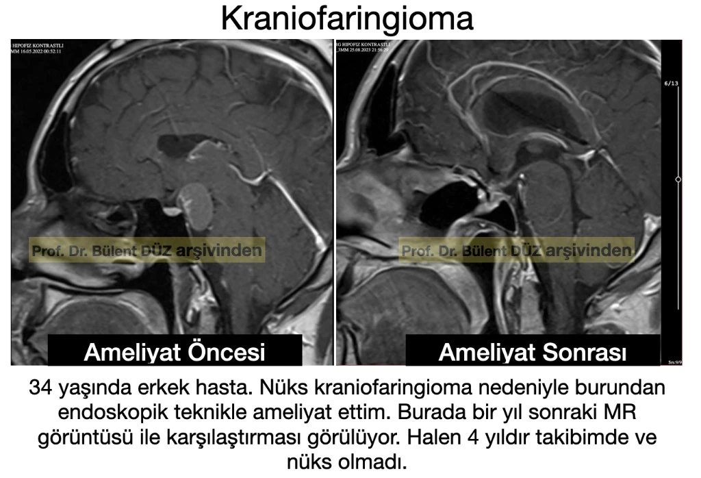 Nüks kraniofaringioma endoskopik ameliyat öncesi ve sonrası MR görüntüsü