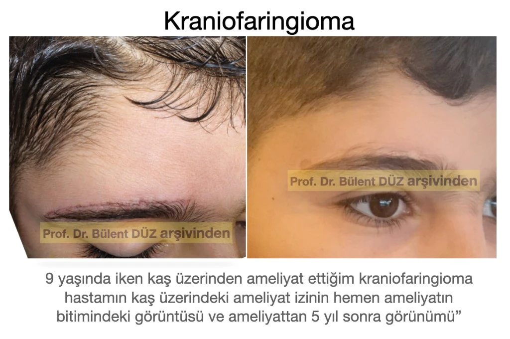 Supraorbital kraniofaringioma ameliyatı sonrası kaş insizyonunun beş yıllık görünümü