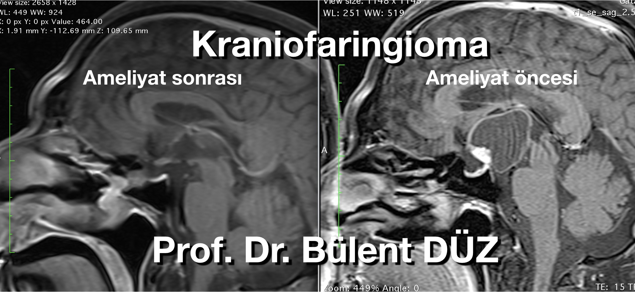 Kraniofaringiomanın ameliyat öncesi ve sonrası sagittal MR görüntüleri
