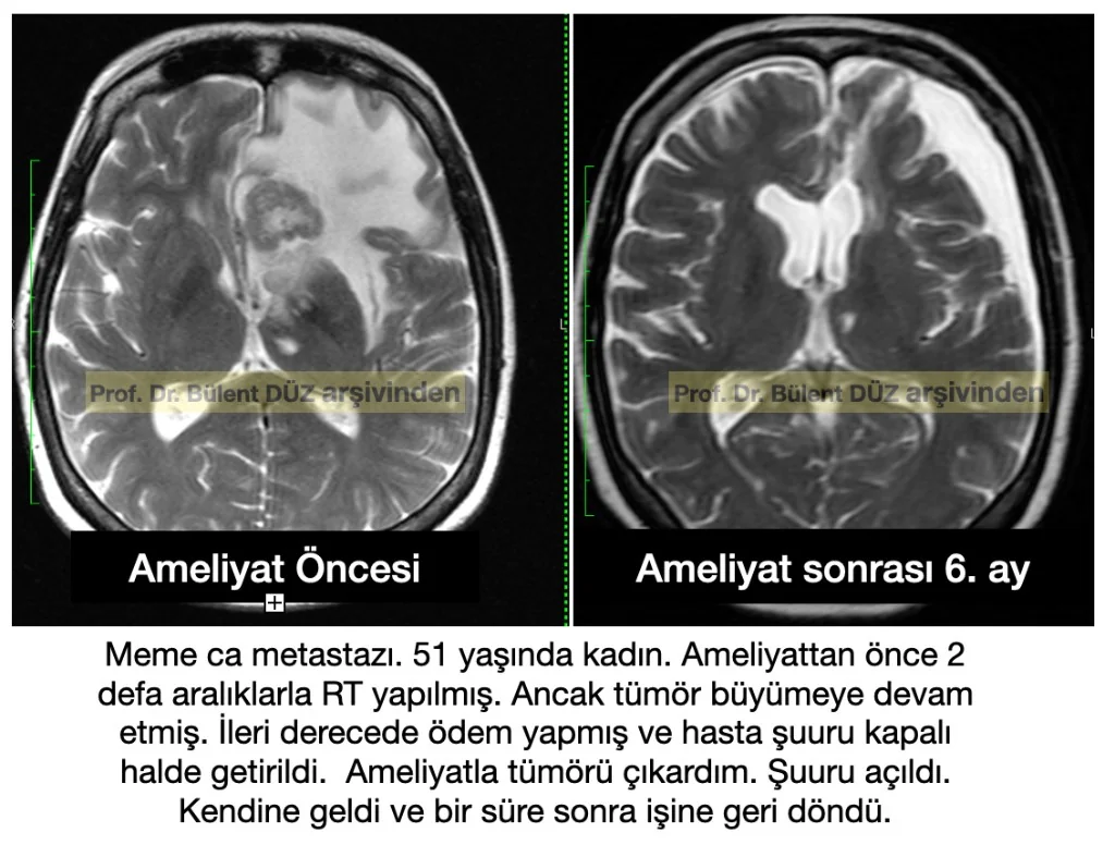 Radyoterapi sonrası büyüyen meme kanseri beyin metastazının ameliyat öncesi ve ameliyat sonrası beyin MR görüntüsü