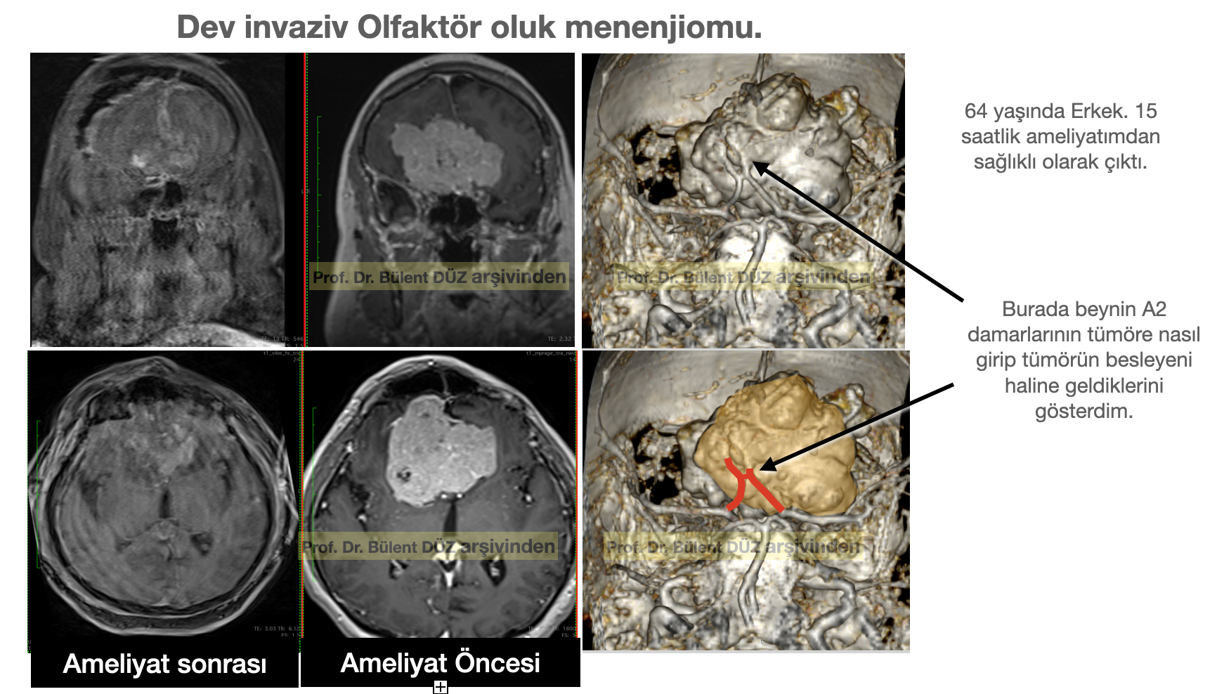 Dev olfaktör oluk menenjiomunun ameliyat öncesi ve sonrası MR ve damar görüntüleri