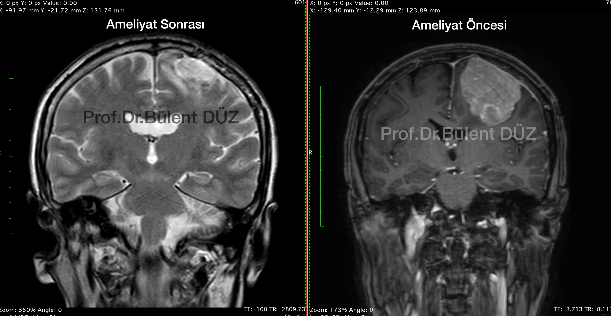 Dev parietal menenjiomun ameliyat öncesi ve sonrası koronal MR görüntüleri
