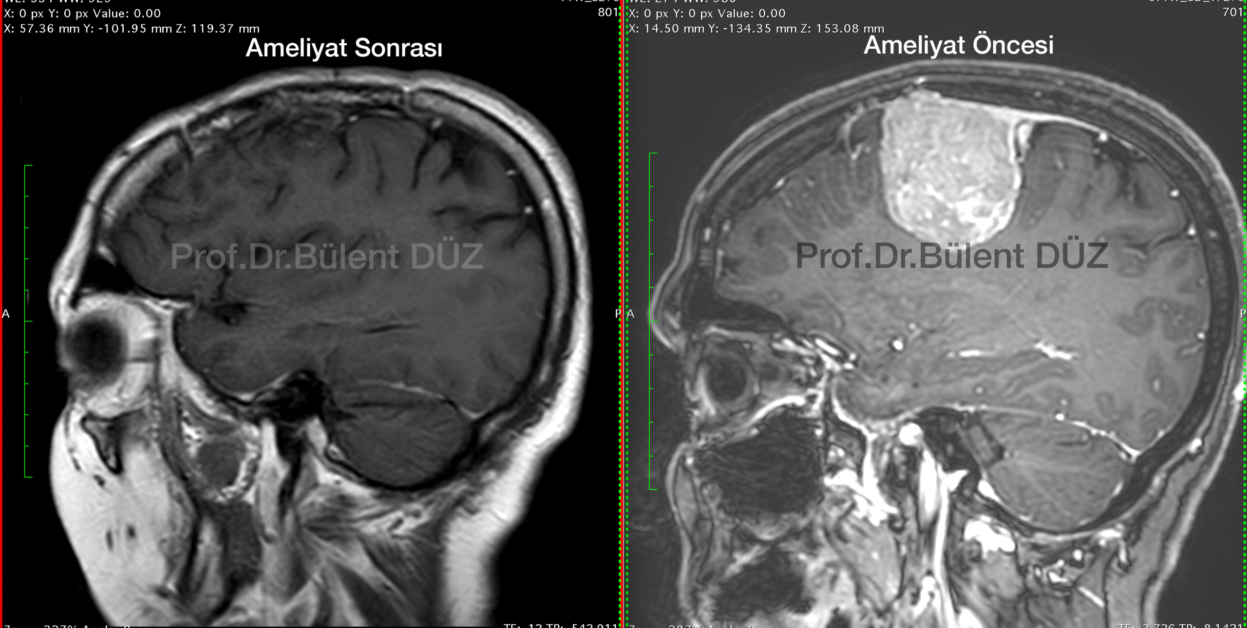 Dev parietal menenjiomun ameliyat öncesi ve sonrası sagittal MR görüntüleri