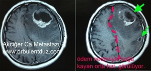 Akciğer kanseri beyin metastazı ve çevresindeki ödemin MR görüntüsü