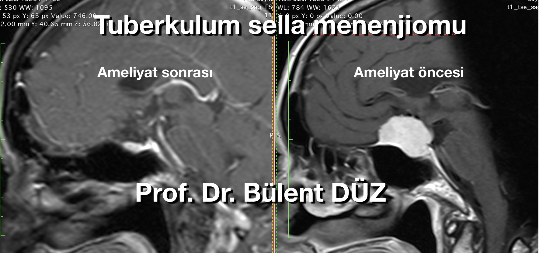 menenjiom_en_iyi_bulent_duz_3