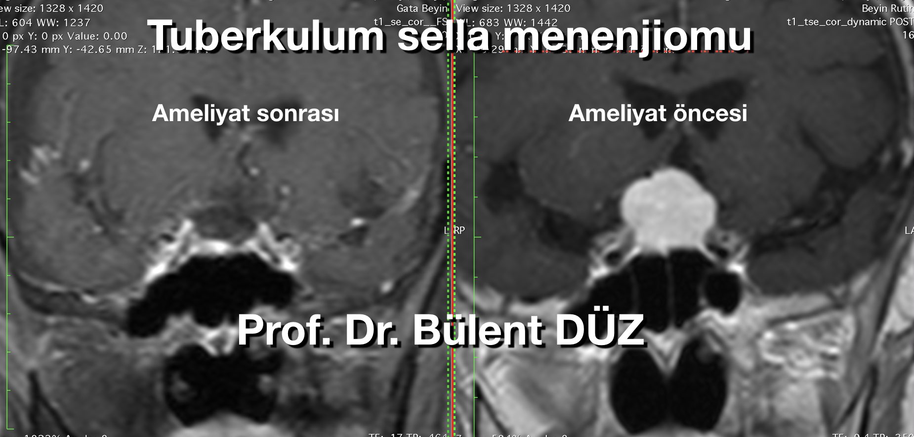 menenjiom_en_iyi_bulent_duz_4