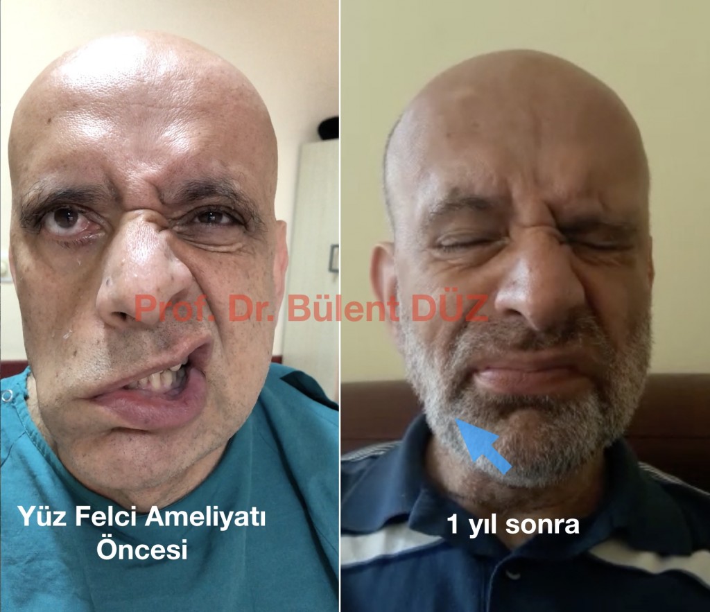 yaz_felci_ameliyatı_sonrası_en_iyi_beyin cerrahı_bulent_duz